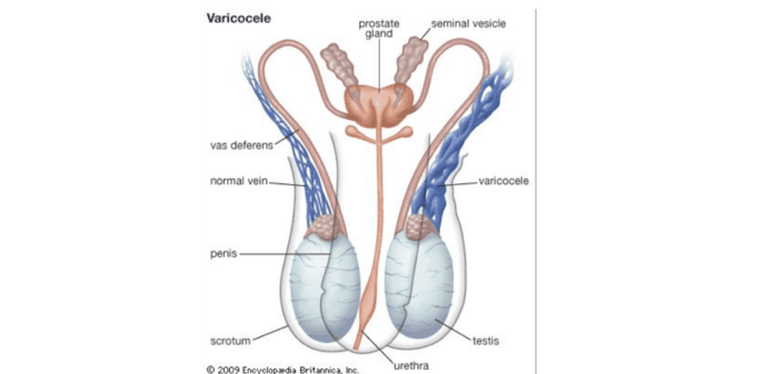 Il varicocele ✿