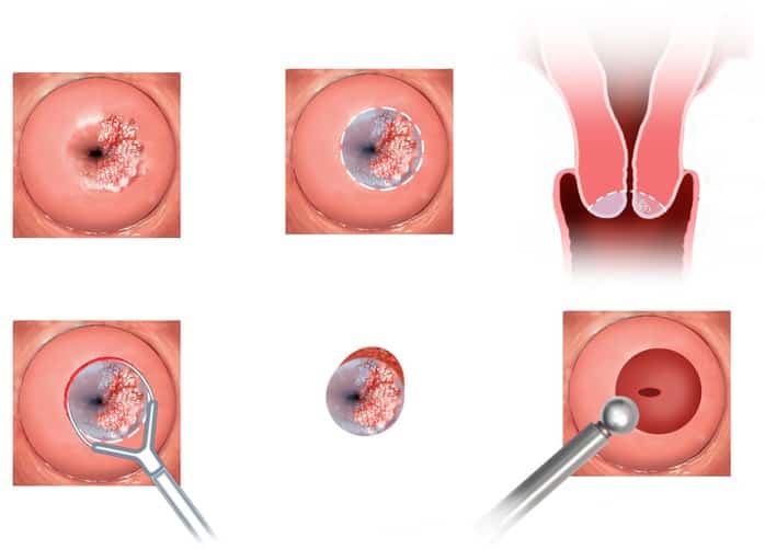 Tumori al collo dell’utero: il test del DNA ✿