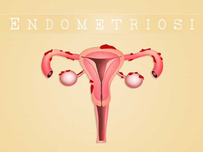 Endometriosi ✿